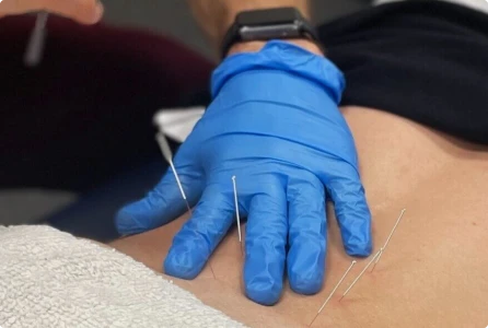 dry needling
